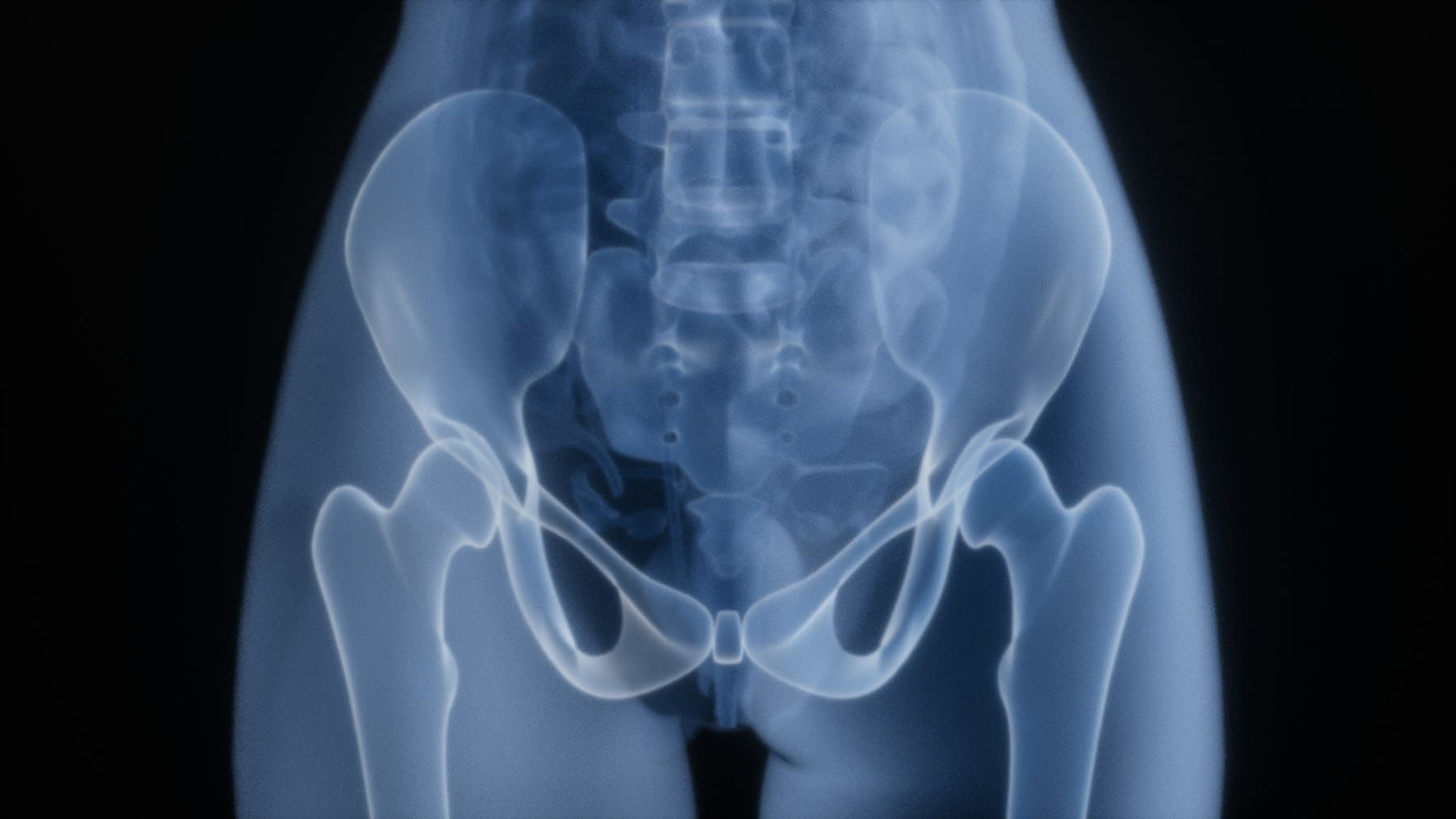 X-ray image of a human pelvis and hip joints