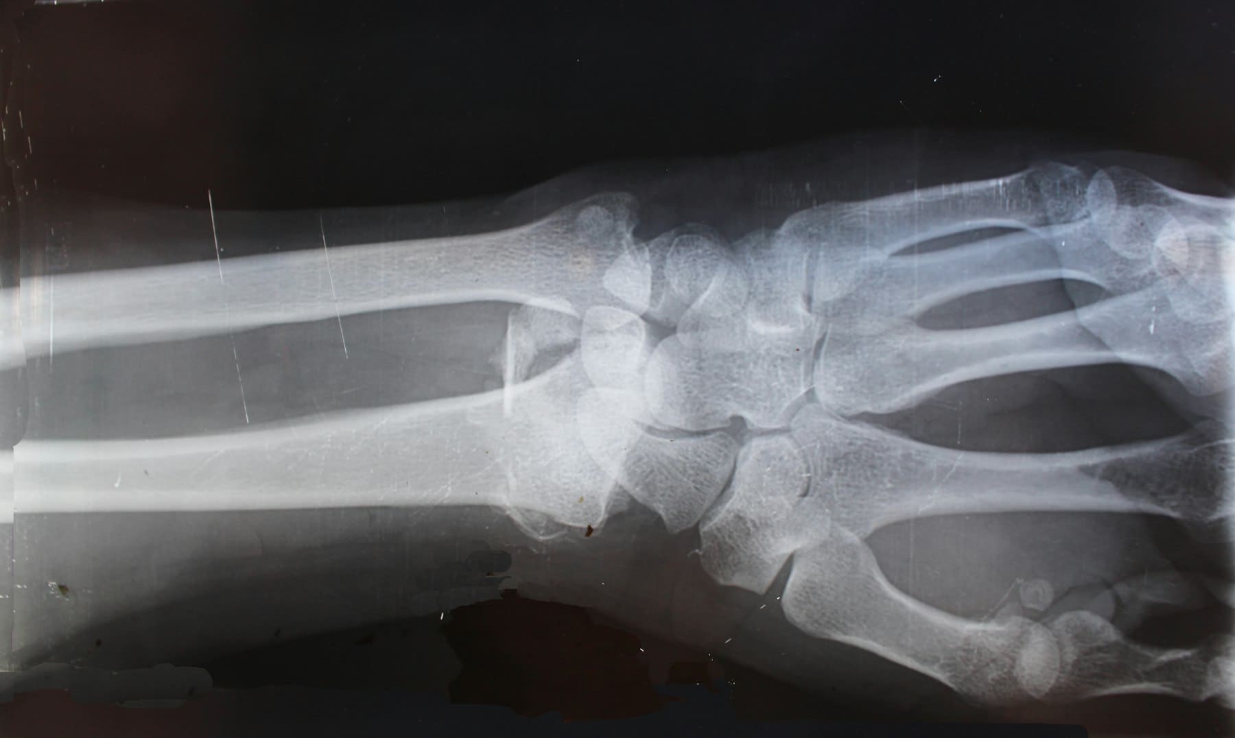 X-ray film of a human forearm and wrist bones
